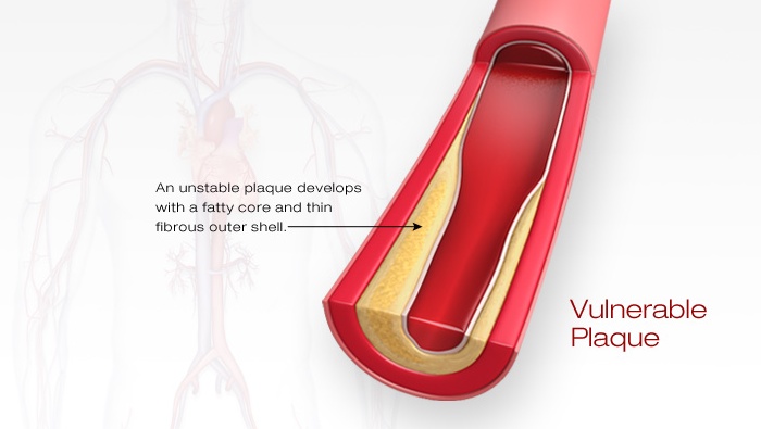 Atherosclerosis and Stroke