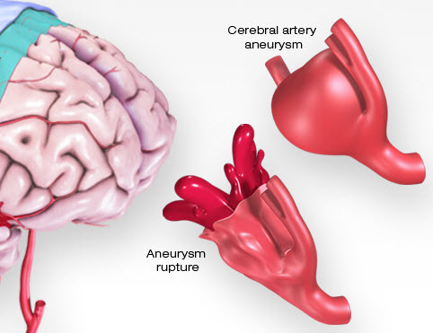medical illustration of an aneurysm