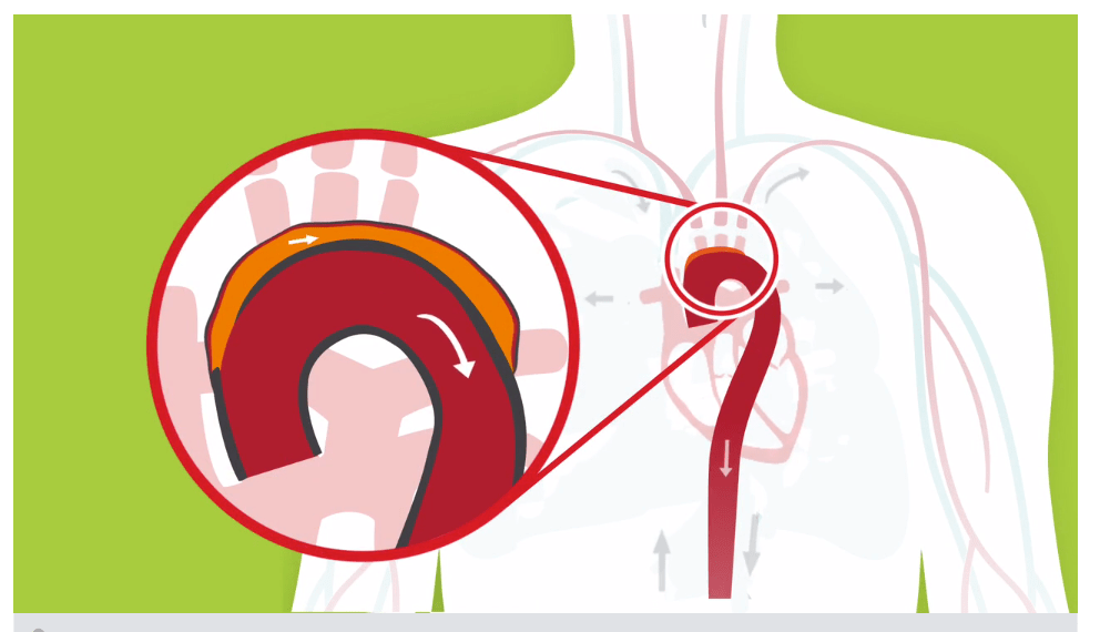 imagen médica de una aorta