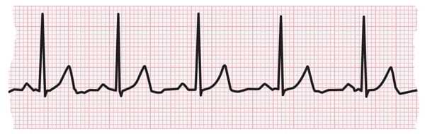 Tira de ECG que muestra latidos cardíacos normales