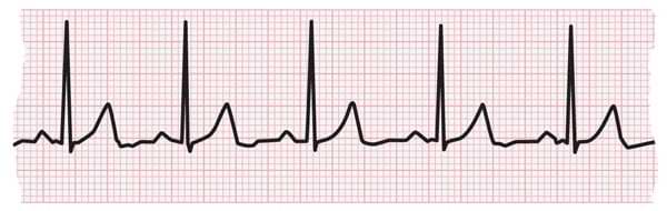 Tira de ECG que muestra latidos cardíacos normales
