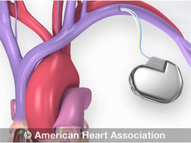 Watch an animation of a pacemaker