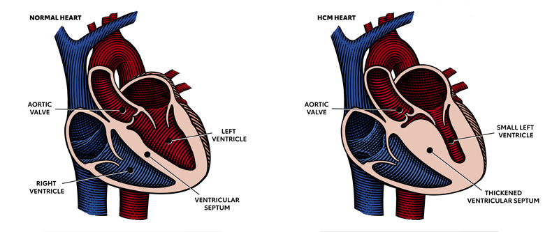 Diagrama en el que se muestra un corazón normal y uno con MCH