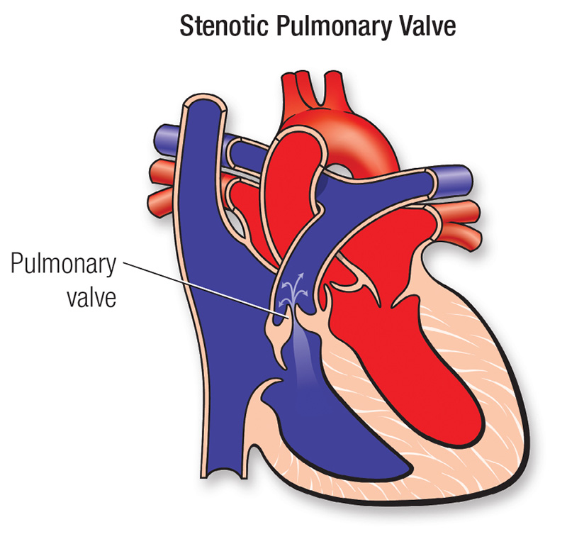 diagrama de la estenosis pulmonar