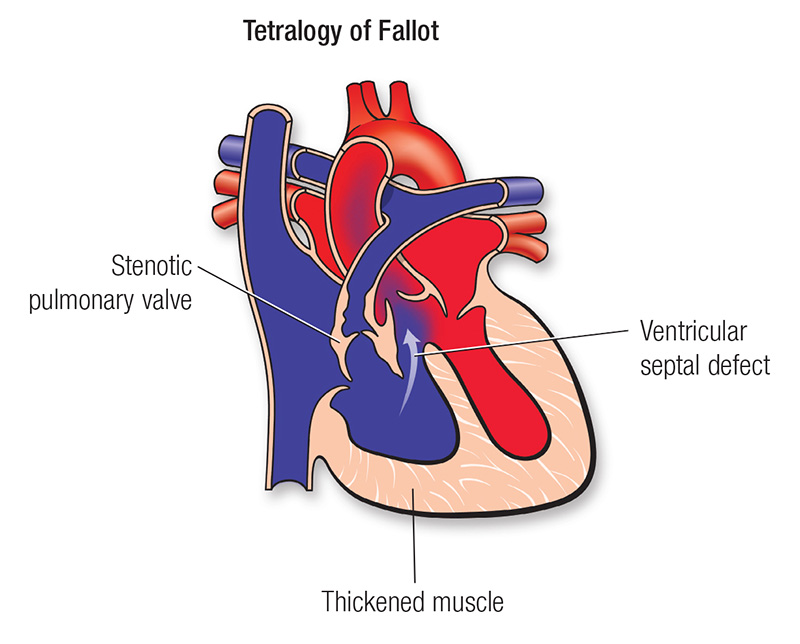 Diagrama de la tetralogía de Fallot