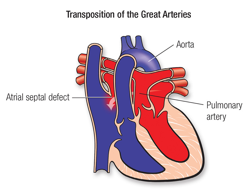 Diagrama de dextrotransposición de las grandes arterias