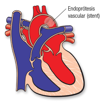 Stent en CoA Español