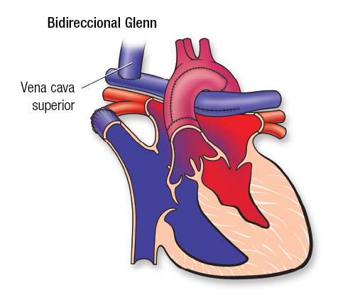 HLHS Bi Glenn SP