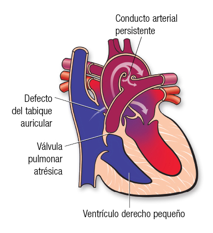 Atresia pulmonar Español