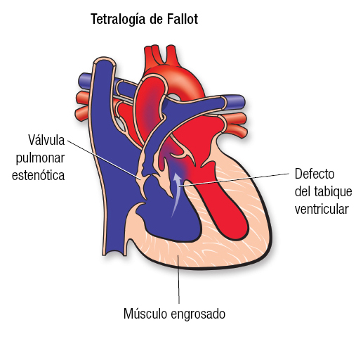 Tetralogy SP