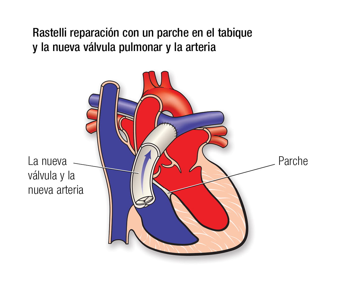 Rastelli repair in Spanish