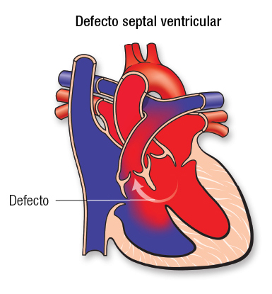 VSD SP