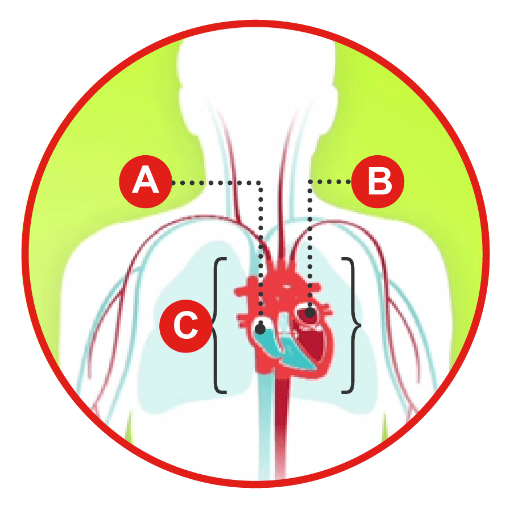 Diagrama de tipos de insuficiencia cardíaca