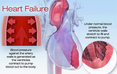 heart failure