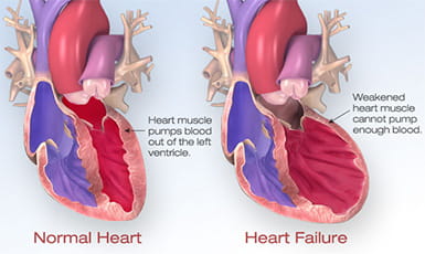 heart failure