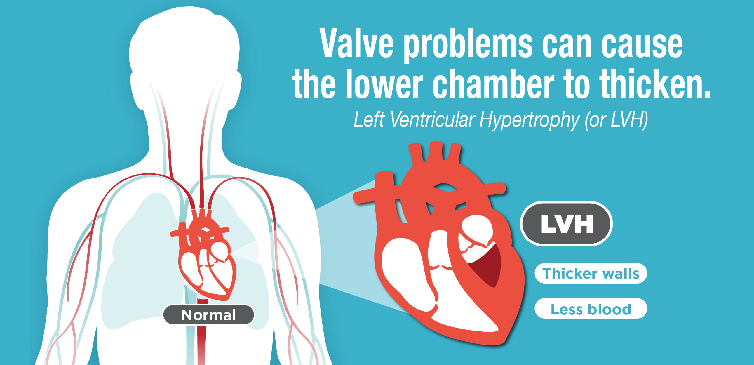 banner de la hipertrofia ventricular izquierda HVI