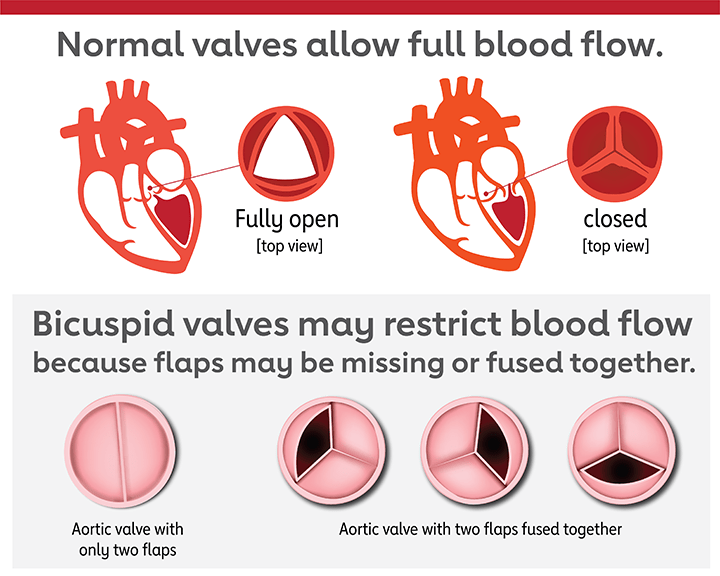 bicuspid valves may restrict blood flow