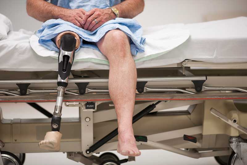 Man sitting on gurney with prosthetic leg
