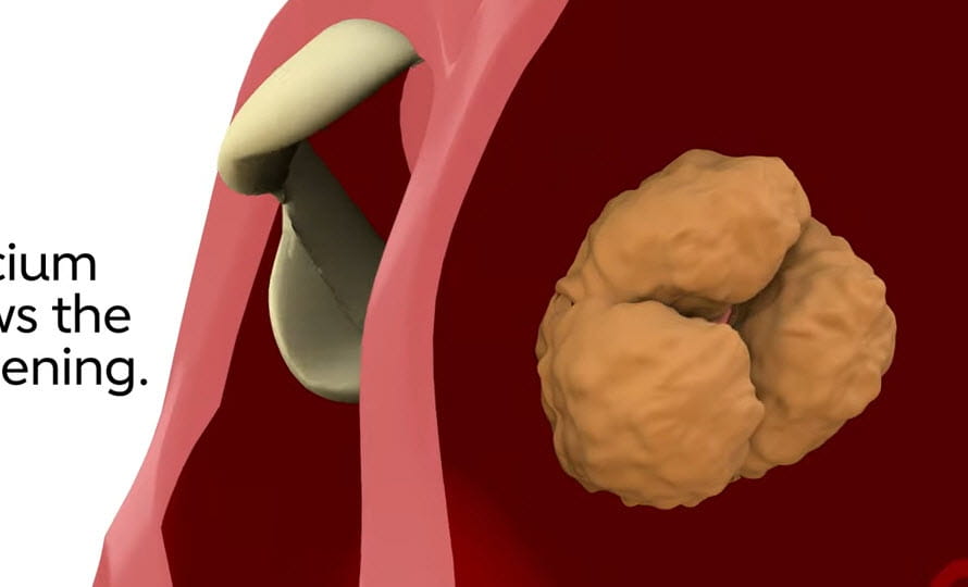 Video sobre qué es la estenosis aórtica