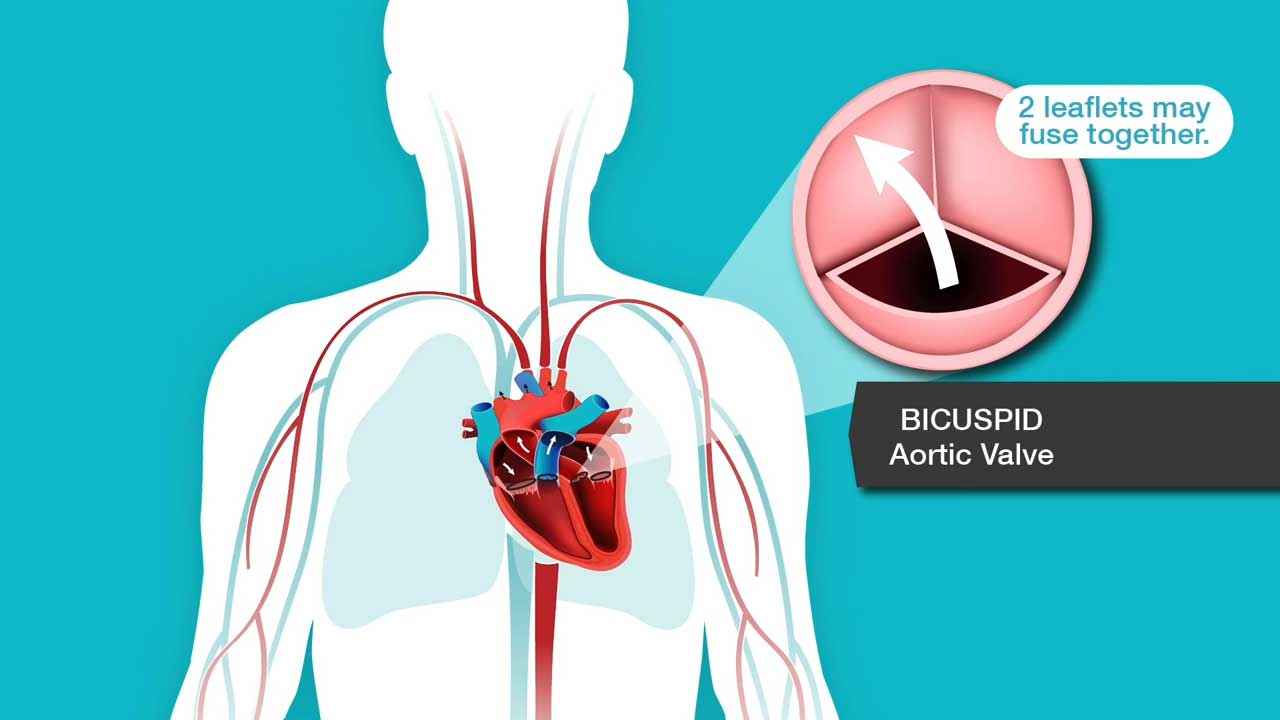 Captura de pantalla del video Aprenda sobre las Válvulas Aórticas Bicúspides