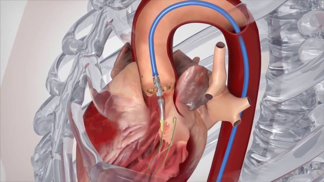 Captura de pantalla del video Factores que influyen en la recuperación de la cirugía de válvula cardíaca