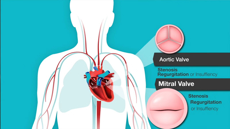 Captura de pantalla del video Comprensión de los Soplos Cardíacos y los Problemas de la Válvula Mitral y Aórtica