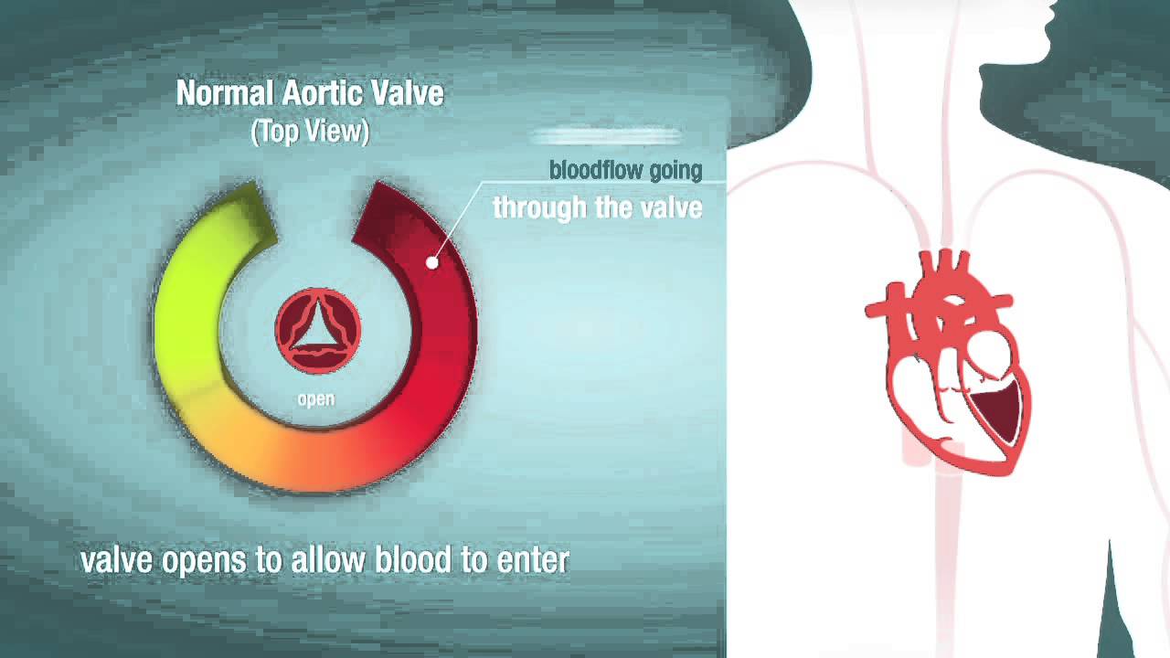 Captura de pantalla del video Estenosis de la Válvula Cardíaca