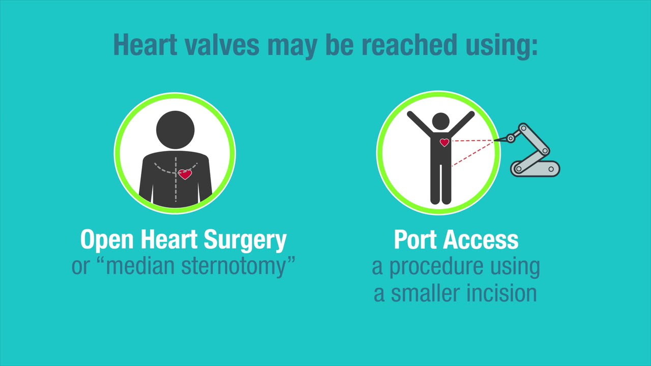 Captura de pantalla del video Heart Valve Treatment Options