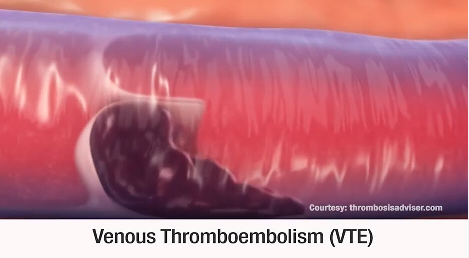 Captura de pantalla del video Tromboembolia venosa