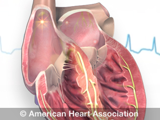 atrial fibrillation