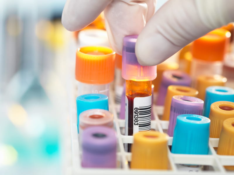 Predicting heart disease, stroke could be as easy as a blood test Go