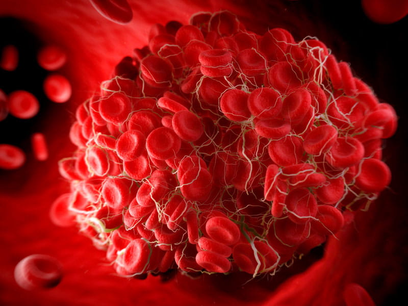 Blood clot risk remains elevated nearly a year after COVID19 Go Red