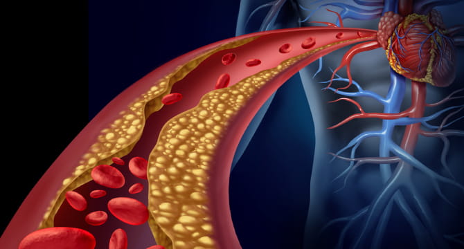 Generic graphic showing a body and close-up of  artery clogged with plaque. 