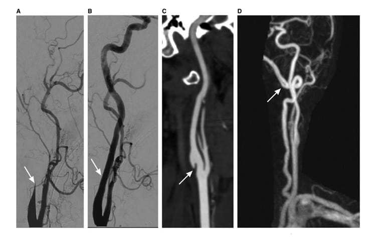 Treatment and Outcomes of Cervical Artery Dissection in Adults ...