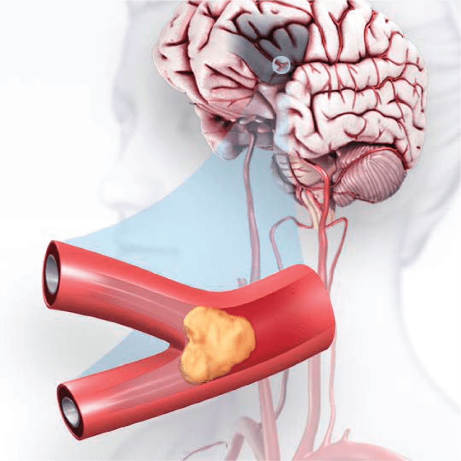ilustración digital de un ataque o derrame cerebral