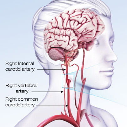 illustration of a translucent person showing their brain, right internal carotid artery, right vertebral artery, and right common carotid artery