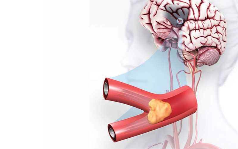 Illustration of a Stroke