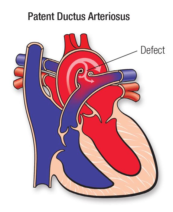 Patent Ductus Arteriosus (PDA) | Go Red for Women