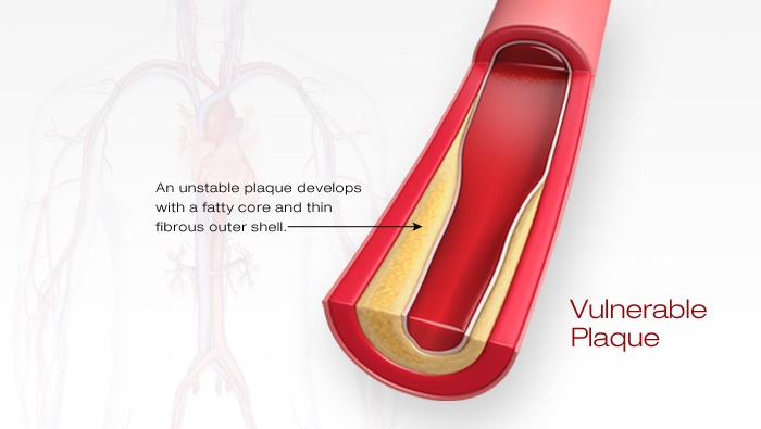 Atherosclerosis vulnerable plaque animation